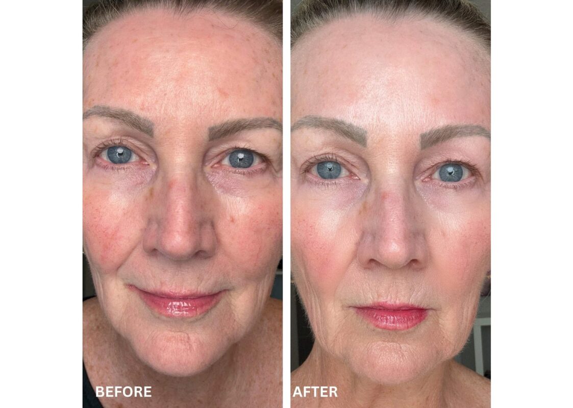 Shark Beauty CryoGlow Under-Eye Cooling LED Anti-Aging Mask Lilac 5